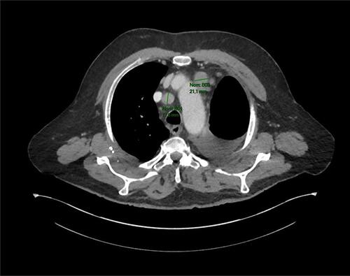 Figure 3 CT scan of February 5, 2020 revealing a mediastinal lymph node progression (RECIST 1.1) with a 21 mm adenopathy in front of the aortic arch and a second one of 18 mm in the pretracheal space.