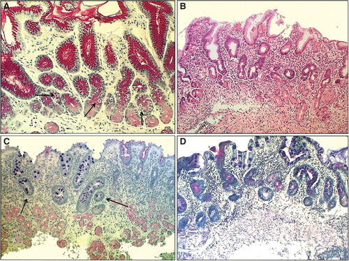 Figure 3. Antral mucosa. Normal (A): Normal number of antral G cells with typical “hallo” appearances occur in neck area of the pyloric glands (arrows). Non-atrophic chronic gastritis (B): Mononuclear inflammation occupies the whole mucosa giving an impression of gland loss (atrophy). Atrophic gastritis of mild to moderate degree in antrum (C): Inflammation is relative mild but there is a large area of pyloric glands lost and replaced with metaplastic glands (IM) as indicated with arrows. Severe atrophic gastritis in antrum (D): All pyloric glands are gone and the whole mucosa is “intestinalized”. Inflammation is mild, or moderate at most. Also the antral G cells are disappeared along with the loss of the normal pyloric glands. Therefore, the G-17 feedback response in physiological control of acid secretion is impaired. HE and Alcian blue – PAS stains × 300.