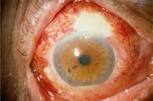 Figure 3 Bleb-related endophthalmitis (note the purulent filtering bleb and hypopyon).