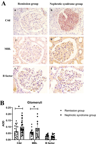 Figure 3 (A) Immunohistological chemistry staining for C4d (a and b), MBL (c and d), and Factor B (e and f) expression in the glomeruli of the remission group and the nephrotic syndrome group respectively (original magnification×400). (B) The expression of C4d, MBL, and Factor B in the two groups. *p < 0.05.