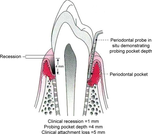 Figure 1 Probing pocket depth (PPD – distance in millimeter from gingival margin to base of pocket) and clinical attachment loss (CAL – distance in millimeter from cement–enamel junction to base of pocket).