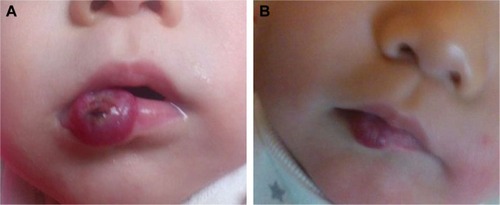 Figure 2 (A) A 2-month-old female patient had a large hemangioma located on her right lower lip which showed ulceration on its surface. (B) The hemangioma on the same patient significantly improved after 5-month treatment of oral propranolol.