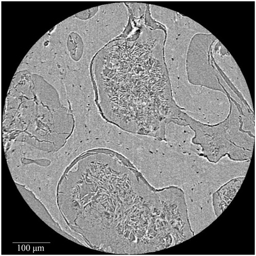 Figure 3. Synchrotron radiation-based micro-CT single projection of a cancellous bone cylindrical Volume of Interest. Probable soft tissue remnants are evident between the trabecular struts. Scale = 100 μm. Credit: JM Andronowski. Reprint permission granted by the publisher.