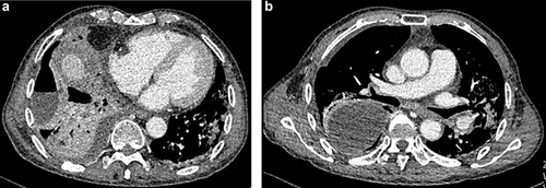 Figure 1 (a and b) Images of chest-computed tomography scan of the multiple-encapsulated pyopneumothorax in the right hemithorax and pulmonary inflammation at admission.