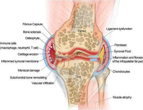 Figure 1 Schematic of an osteoarthritis (OA) joint. OA is a disease of the entire joint in which various tissues in the joint are affected and undergoing progressive lesions, including 1) cartilage degradation and breaking down; 2) bone remodeling and sclerosis; 3) osteophytes formation; 4) synovial hypertrophy/synovitis; 5) meniscal damage; 6) ligament dysfunction; 7) muscle atrophy; and 8) inflammation/fibrosis of the infrapatellar fat pad.