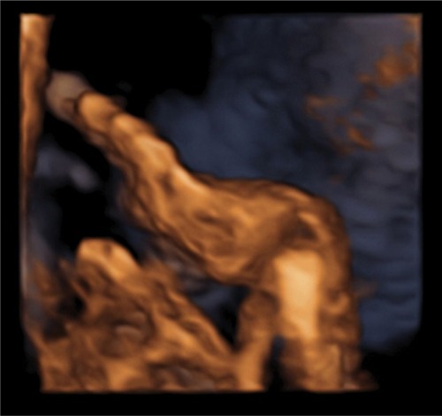 Figure 1 3-D rendering of fetal hand, showing abnormal posturing due to metacarpal joint subluxation.