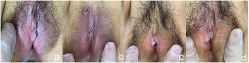 Figure 3. Lesion size changed after FU treatment at 2.5 mm focal depth. (a) one patient’s vulvar lesion before FU treatment, (b) 7 days after FU treatment, (c) 3 months after FU treatment and (d) 6 months after FU treatment.