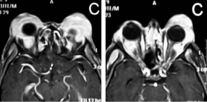 Figure 3 Coronal images obtained by magnetic resonance imaging showed a homogeneous mass involving bilateral infratemporal fossa, nasale cavity, lacrimal gland, and buccal and perimandibular interface in the left side.