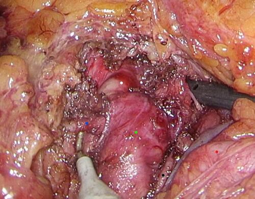 Figure 4 Transperitoneal laparoscopic celiac artery (CA) decompression for median arcuate ligament syndrome. The white dot represents the decompressed segment of CA originating from the aorta, and the green dot represents the post-stenotic dilated segment of the CA. The blue dot represents the right inferior phrenic artery. Black and red dots represent the left gastric artery and splenic artery, respectively.