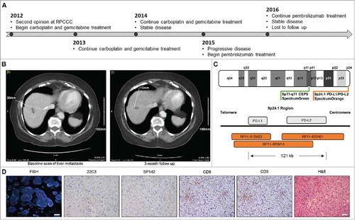 Figure 1. Immunological characterization of unexpectedly durable disease stabilization in urothelial carcinoma patient treated with pembrolizumab. A. Clinical timeline. B. Baseline and follow-up CT scan of hepatic metastasis. C. Design of FISH probes for CD274 and PDCD1LG2 copy number evaluation. D. Representative images for CD274 and PDCD1LG2 amplification by FISH, CD3 and CD8 detection by IHC, PD-L1 expression levels as monitored by the SP142 and 22C3 assays, and hematoxylin and eosin (H&E) stain. FISH, scale bar = 20 µm. IHC, scale bar = 100 µm.