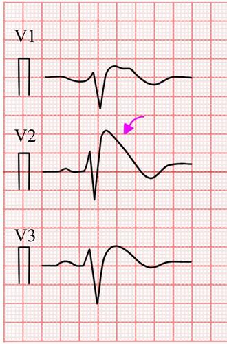 Figure 2 Brugada type 1 (pink arrow: Coved type ST-segment elevation in V2).