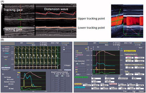 Figure 1. (A) Movement of the vessel wall is tracked automatically and displayed on M-Mode. Waveforms changes in vessel diameter (distension wave) in real time (left side) and in the right side solid line shows the ultrasound beam direction for velocity measurements, whereas the dotted line shows the beam direction for measurements of diameter change. Both beams were steered to intersect at the center of the range gate. (B) Graphic: Carotid diameter change (top); blood pressure wave and electrocardiographic tracing (bottom). Representative output of carotid stiffness parameters.