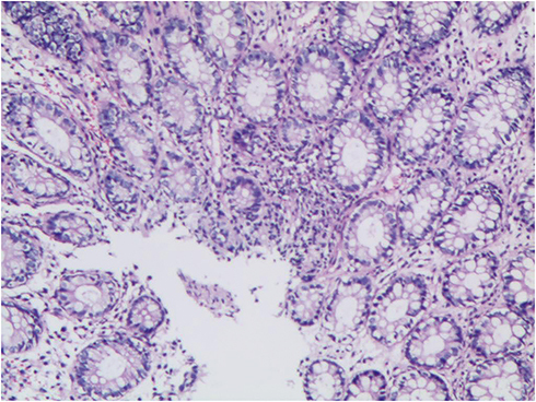 Figure 3 Pathological biopsy of the rectum, ascending colon, transverse colon, and cecum: chronic inflammation of the (rectal) mucosa.