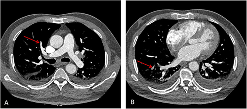 Figure 1 Pulmonary CT angiography of the patient. As the arrow showed scattered multiple emboli in the right upper pulmonary artery (A) and lower pulmonary artery (B).