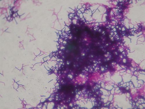 Figure 2. Gram stain of the culture material showing beaded, branching filamentous gram-positive bacilli.