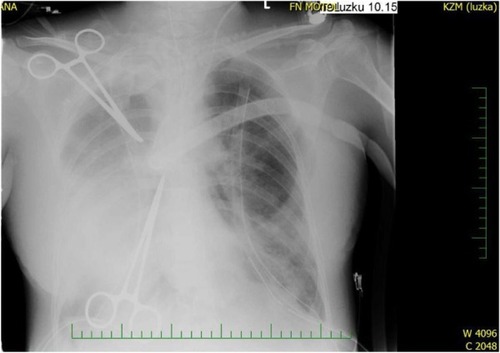 Figure 4 Chest X-rays, 1 week after thrombolysis.