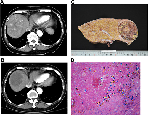 Figure 4 (A) Pre-treatment CT study showing arterial-enhancing tumor. (B) Post-treatment CT study showing necrotic changes of the tumor. Photograph (C) and photomicrograph (D) of the liver specimen shows complete tumor necrosis and staining of resin microspheres in the tumor.