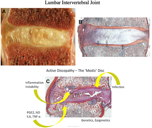 Figure 2 (A) Gross morphology of the lumbar intervertebral joint, (B) with the corresponding histological stain. (C) Histological depiction of endplate damage. Reproduced with permission from otz JC, Fields AJ, Liebenberg EC. The role of the vertebral end plate in low back pain. Global Spine J. 2013;3(3):153–164, Copyright 2013, SAGE Publication;Citation2 and Dudli S, Fields AJ, Samartzis D, Karppinen J, Lotz JC. Pathobiology of Modic changes. Eur Spine J. 2016;25(11):3723–3734, copyright 2016, Spring Nature.Citation55