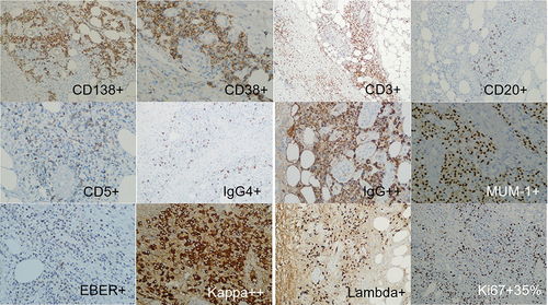 Figure 3 Immunohistochemistry Results after the First Biopsy: CD138 (+), CD20 (small focal +), CD3 (partially +), CD30 (partially weak +), CD38 (+), CD5 (small focal +), IgG (+), IgG4 (+), IgG4/IgG ratio approximately 40%, Kappa (+), Ki-67 (+, hot spot 35%), Lambda (+), MUM1 (+), EBER1/2 in situ hybridization (small focal +).