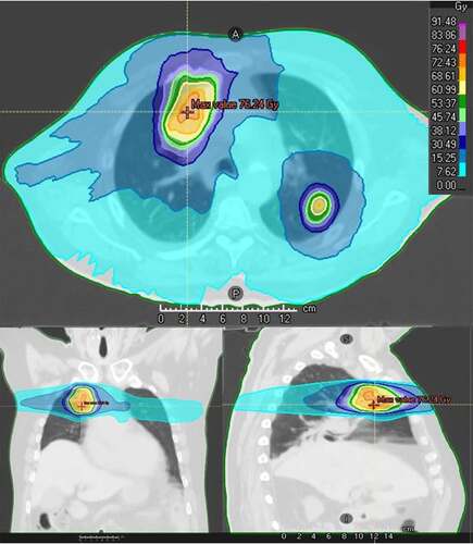 Figure 4. An example of patient treated with high-dose focal RT, 60 Gy in 8 fractions on 2 pulmonary lesions, illustrating large incidental low-dose radiation surrounding treated volumes.