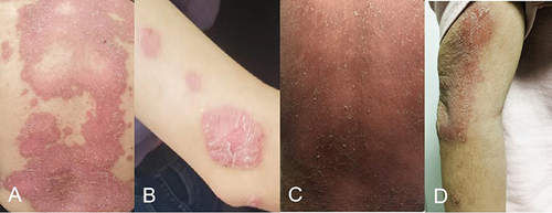 Figure 1 Clinical manifestations of the patient’s back and upper extremities 1 month prior to treatment, PASI:25.4 (A and B). Clinical manifestations of the patient’s back and upper limbs in this visit, PASI:35.6 (C and D).
