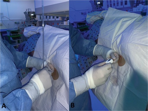 Figure 1 Images of two forms of pressure measurement used during study in the lateral decubitus position. (A) Water column manometer directly attached to needle via a 4-way stopcock and (B) The digital compass device attached directly to needle.