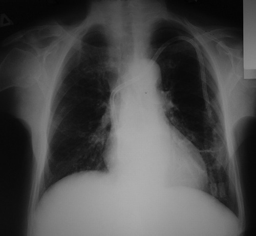 Figure 2. Chest radiography: hemodialysis catheter’s tip positioning into the right atrium.