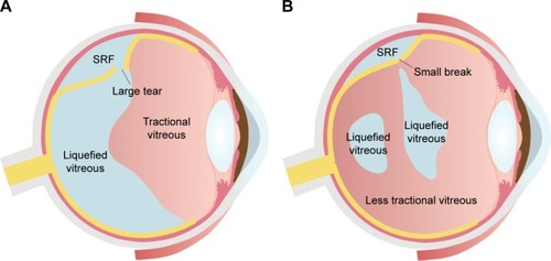 Figure 1 Two patterns of RRD based on the presence of PVD.