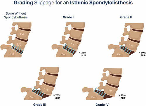 Figure 1 The grading of isthmic spondylolisthesis based on the degree of slippage of one vertebral body on the adjacent vertebral body (Grade I <25%; Grade II: 25–50%; Grade III: 50–75%; Grade IV: 75–100%).