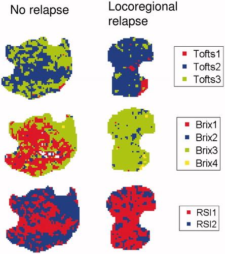 Figure 1. Tofts (top), Brix (middle) and RSI (bottom) voxel clusters in the central slice of tumors from two different patients. These patients had no relapse (left) or locoregional relapse (right), respectively. The white areas in some of the slices are voxels excluded due to unphysiological parameter values.