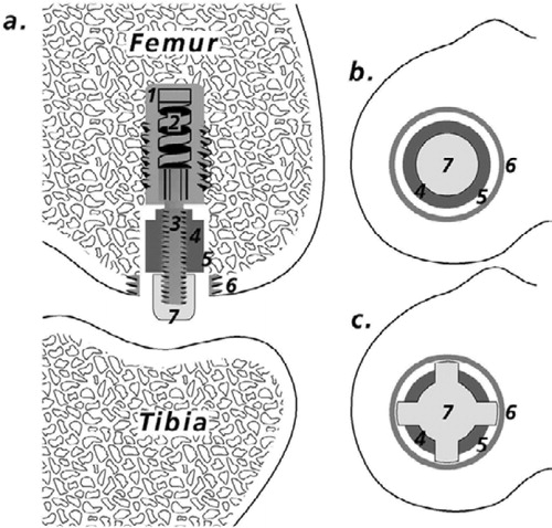 Figure 2. Implant devices. a. Implant device and test implant positioned in the weightbearing part of the femoral condyle (modified from Søballe et al. (Citation1992b, Citation1993)). 1. Threaded anchorage screw fixed in bone. 2. In the micro-motion device, a spring allows the piston to move 500 μm vertically. At each gait cycle, the PE plug and the implant were displaced 500 μm by tibia. When the pressure on the plug was released, the implant and plug were repositioned by means of a spring in the anchorage screw. 3. Threaded piston, which is centralized in the drilled hole by the anchorage screw. 4. Test implant mounted on the piston. 5. Gap measuring 0.75 mm, between implant surface and trabecular bone. 6. Titanium ring inserted into the subchondral part of the condyle to prevent early tissue ongrowth to the polyethylene plug. 7. Protrusion of the polyethylene plug (diameter 4.5 mm), which transmits the load from the tibial part of the knee to the implant system. b. Stable implant devices. Appearance of the femoral condyle after implantation of the stable implant device. Note the gap between the PE plug and the titanium ring, which allows the joint fluid access to the bone-implant interface. c. Unstable implant devices. The PE plug used for the micromotion devices had four tabs measuring 1 mm2. The extensions were added to ensure only vertical movement in the system. There was a gap of 250 μm between the ring and the PE plug tabs. It was possible for joint fluid to gain access to the bone-implant interface between the tabs.