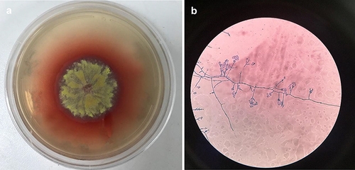 Figure 2 Macroscopic and microscopic features of TM. (a) The TM from the patient’s BALF cultured on Sabouraud dextrose agar showed short yellow villi and produced red pigment (incubation at 27°C). (b) Stained with lactophenol cotton blue, the fungi showed brush-like structure (original magnification: ×400).