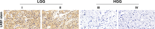 Figure S5 Immunostain for LKB1 in LGG and HGG.Notes: Magnification ×20.Abbreviations: HGG, high grade glioma; LGG, low grade glioma; LKB1, liver kinase B1.