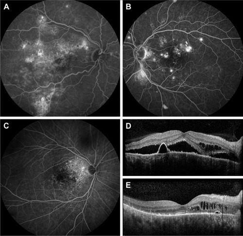 Figure 1 Illustration of the 4 criteria of severity on FA and OCT.