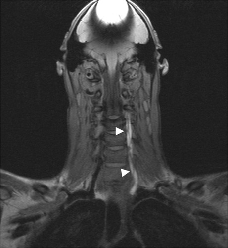 Figure 3 The coronal fat-saturated T1-weighted MRI sequence shows dissection of the left VA (arrow heads).