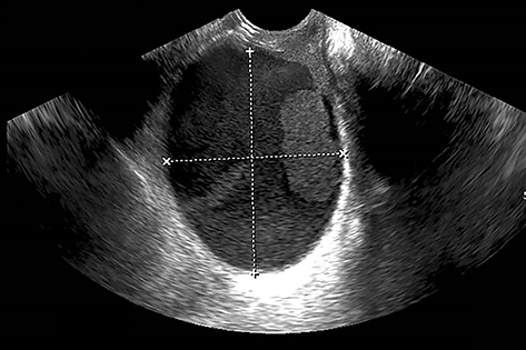Figure 4 Vaginal ultrasound showing a dark, liquid area (2020.06.10).