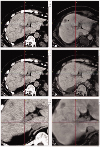 Figure 2. Example images of fused images by superimposition on each other by StealthMergeTM in a patient with impaired renal function. (A, B) Showing fused images of the non-contrast enhanced planning CT with MR images of the previous day. (C, D) Corresponding fused images with 50:50 overlay (native CT and MR) (D). (E, F) Anatomical landmarks used for check of fusion (crosshair).