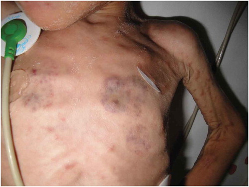 Figure 3. Cutaneous manifestation of disseminated BCG in a SCID patient.