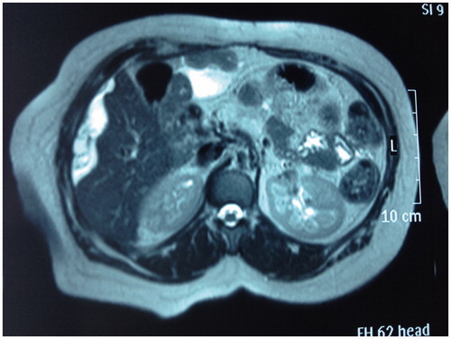 Figure 1. Axial T2 MR imaging: mucinous ascites with several peritoneal implants. White arrow shows the mucinous ascites over the liver surface.