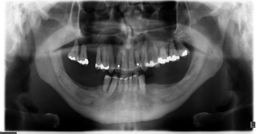 Figure 3. Panoramic view showing the present situation where the bone has healed and the teeth are splinted in the front. The patient displays a clinically stable situation with a healthy gingiva and prosthetic rehabilitation with implants is planned.