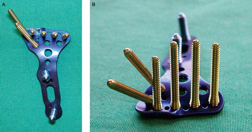 Figure 1. A: The distal fixed-angle screws are angled 6 degrees distally; precontoured plates are used for the volar distal radius. B: This plate has a unique screw hole for insertion at the radial styloid, and the thickness of the plate is 2.5 mm.