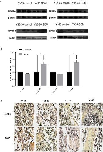 Figure 2 Reduced expression of miR-21 in the placenta of GDM patients and the expression of PPAR-α increases (A and B) PPAR-α in the placenta of GDM patients. The expression levels of PPAR-α in the placental tissue changes with age, and is significantly upregulated in the placental tissues of pregnant women aged 25 years and older. n = 3 per group. (C) Immunohistochemistry was used to detect the PPAR-α distribution. Brown particles are positively colored and are mainly expressed in the placenta and villus tissue. *P<0.05.