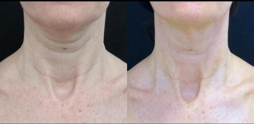 Figure 2 Before and after pictures of a patient treated for skin quality fillers. Treatment description: Neck- Juvederm Volite, 2mL total, in the superficial subcutaneous layer using a needle; Face- Juvederm Volite, 1mL each side, in the superficial subcutaneous layer using a needle. (contributed by Ligia Colucci).