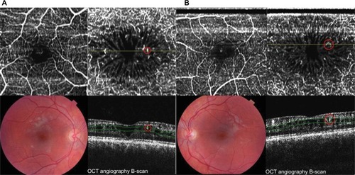 Figure 1 Observations in patient 1. (A) Right eye (left side): 3 × 3 mm fovea-centered OCTA image of pSVP (upper left) shows no perifoveal capillary network interruptions. Hyperreflective retinal abnormalities (ie, microvascular protrusions in red circle) within enlarged foveal avascular zone in the pDVP (upper right). B-scan image (lower right) shows perifoveal-nasal dilated capillary within a schisis cavity (red circle). (B) Left eye (right side): 3 × 3 mm fovea-centered OCTA image of pSVP (upper left) shows inferior-perifoveal capillary network interruption. Hyperreflective retinal abnormalities (ie, microvascular protrusions in red circle) within enlarged foveal avascular zone in the pDVP (upper right). B-scan image (lower right) shows perifoveal-temporal dilated capillaries within a schisis cavity (red circle). Copyright © 2016 Karger Publishers, Basel, Switzerland. Adapted with permission from Stanga PE, Papayannis A, Tsamis E, et al. Swept-source optical coherence tomography angiography of paediatric macular diseases. Dev Ophthalmol. 2016;56:166–173.Citation25