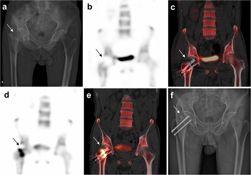 Figure 6 A preoperative radiograph of a 72-year-old male with right Hip pain shows a right femoral neck fracture (Garden stage III) (a). The immediate postoperative bone SPECT (b) and SPECT/CT fusion (c) images at 3 days show a cold defect of the right femoral head. The follow-up bone SPECT (d) and SPECT/CT fusion (e) images at 3 months show partially normalized uptake with the remaining defect in the superior portion of the right femoral head. Postoperative radiograph (f) at 15 months shows avascular necrosis of Ficat stage III with subchondral collapse of the right femoral head. Arrows represent ischemic region.