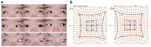 Figure 3 External photograph of the eyes, and Hess chart, three months after the injury. (A) Eye position and eye movements had completely recovered. (B) Hess chart shows recovery of the eye position and movement.