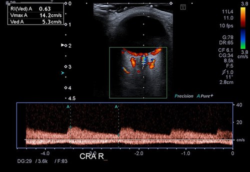 Figure 2 Blood flow spectrum of central retinal artery and central retinal vein in Colour Doppler Imaging.