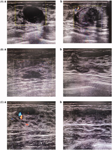 Figure 3. Depicts three cases of patients with different responses to treatment (see figure A, B and C). Ultrasound before MWA showed three lesions with clear boundary (A.a, B.a and C.a). 8 months, 9 months and 11 monthsafter the MWA, showed the results of enlargement (A.b), reduction (B.b) and complete regression (C.b) on ultrasound, respectively.