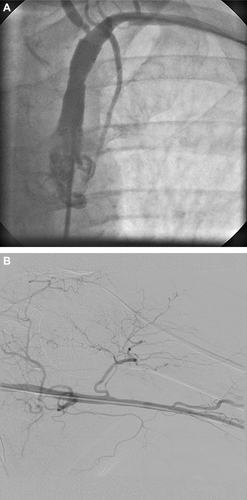 Figure 3 (A) Left subclavian artery 1 day after recanalization and stent implantation and (B) left axillary and brachial arteries after low-dose local lysis demonstrate a completely recanalized vessel without thrombotic material.