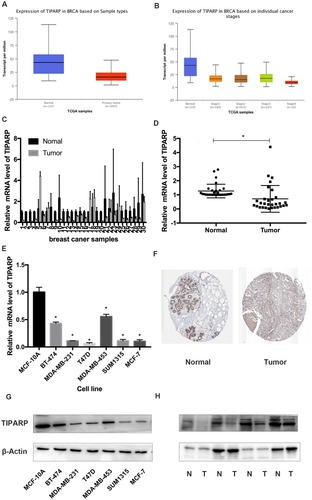 Figure 2 Decreased expression of TIPARP in breast cancer patients tissues. (A) Lower mRNA TIPARP was expressed in breast cancer tissues than in normal tissues (P<0.05) using UALCAN website. (B) Patients with a more advanced stage of breast cancer tended to express lower levels of TIPARP. (C) TIPARP mRNA expression in 30 pairs of breast cancer and adjacent tissues. (D) Average expression level of TIPARP mRNA in 30 pairs of breast cancer tissues and adjacent normal breast tissues. The data are represented as mean ± SD of three independent experiments. * indicates P-value <0.05. (E) The mRNA expression of TIPARP was lower in breast cancer cells compared to normal breast cell line MCF-10A. The data are represented as mean ± SD of three independent experiments. * indicates P-value <0.05 vs MCF-10A. (F) Immunohistochemistry confirmed the lower expression of TIPARP in breast cancer in protein level. (G) The protein expression of TIPARP was lower in breast cancer cells compared to normal breast cell line MCF-10A. (H) TIPARP protein expression in 4 pairs of breast cancer and adjacent tissues.